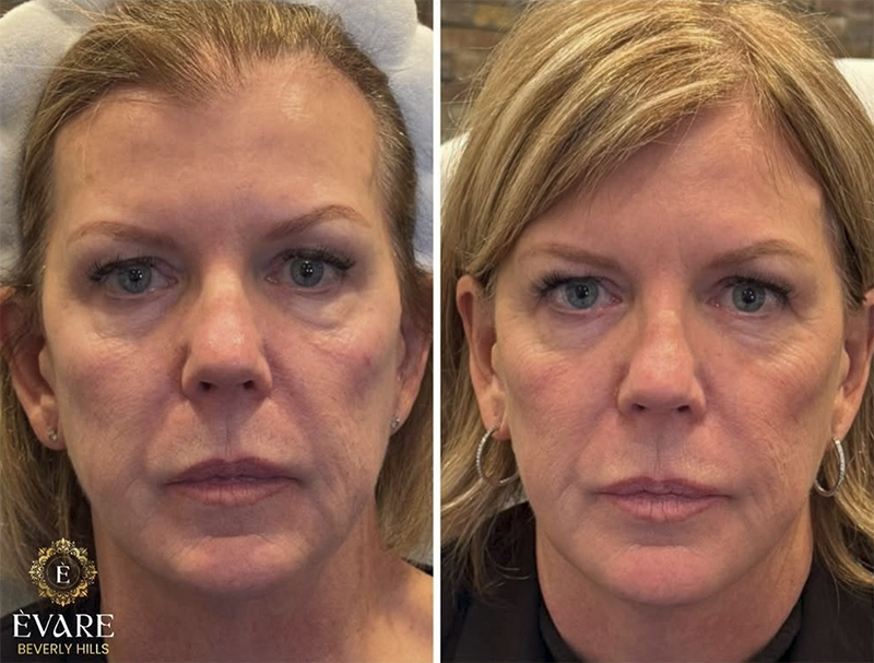 Rejuran Before & After Treatment