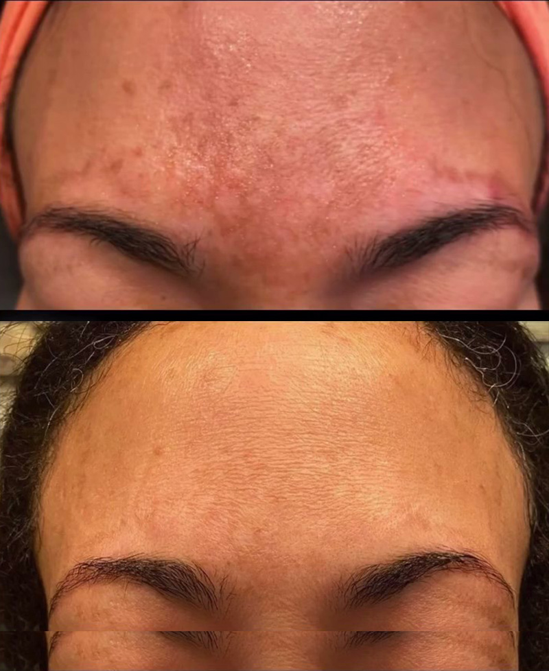 VI Peel Before & After