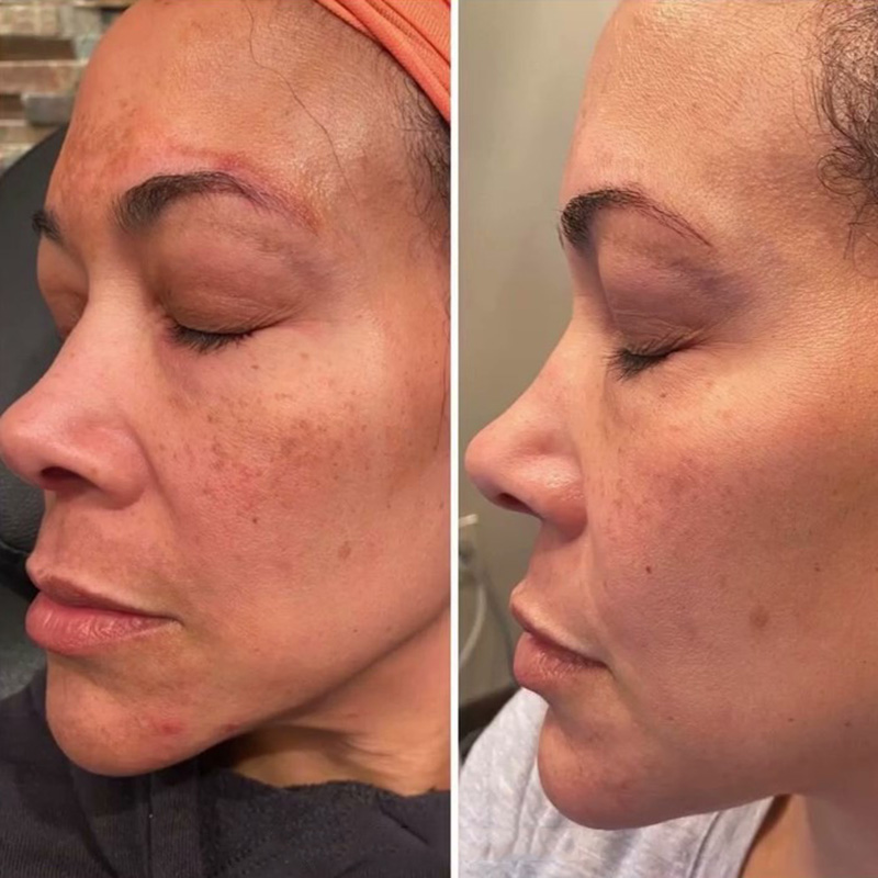 VI Peel Before & After