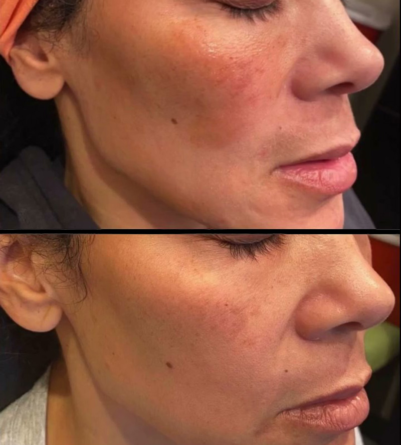 VI Peel Before & After