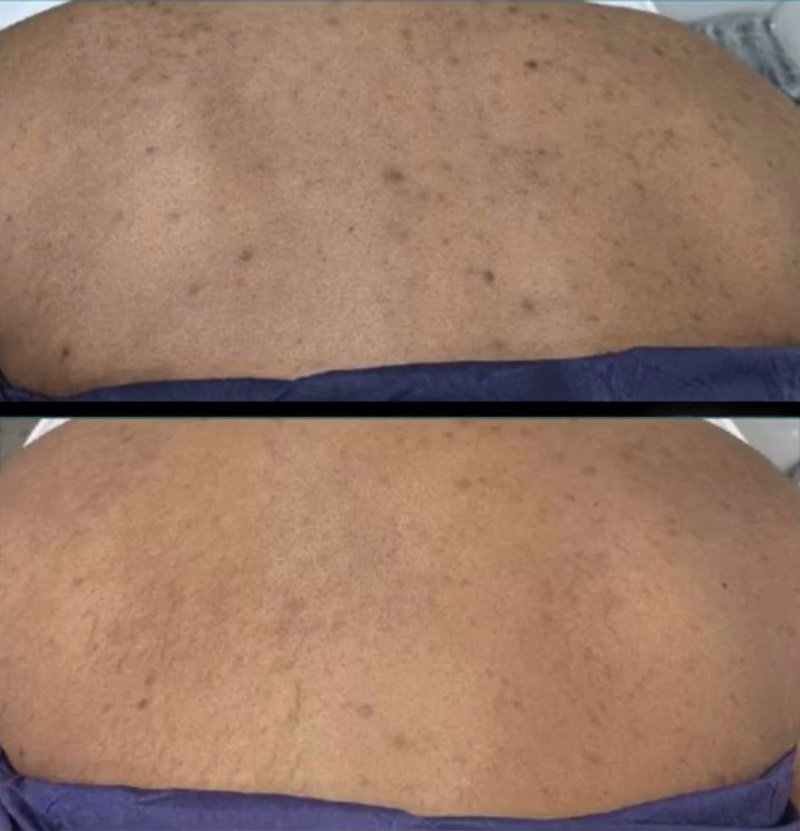 VI Peel Before & After