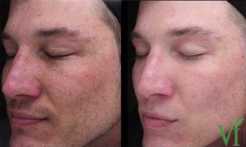 VI Peel Before & After