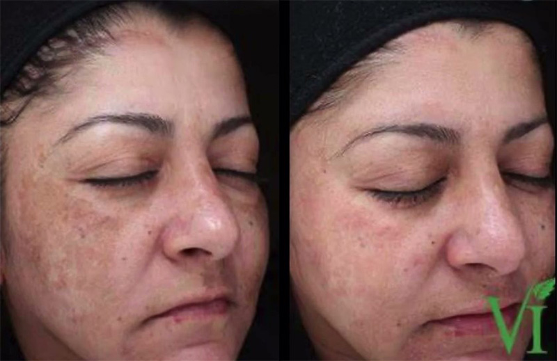 VI Peel Before & After