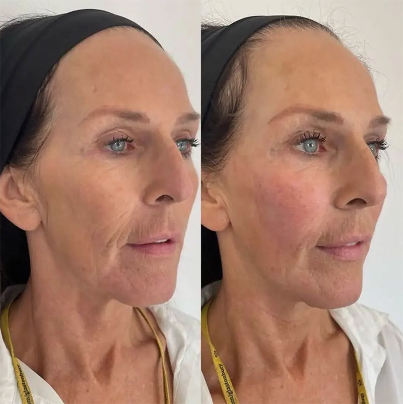 Before & After Treatment w/ HA Fillers