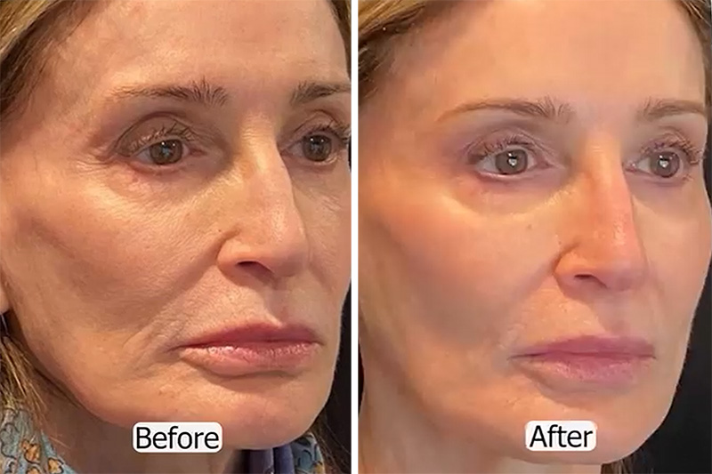 Liquid Facelift using injectable fillers.