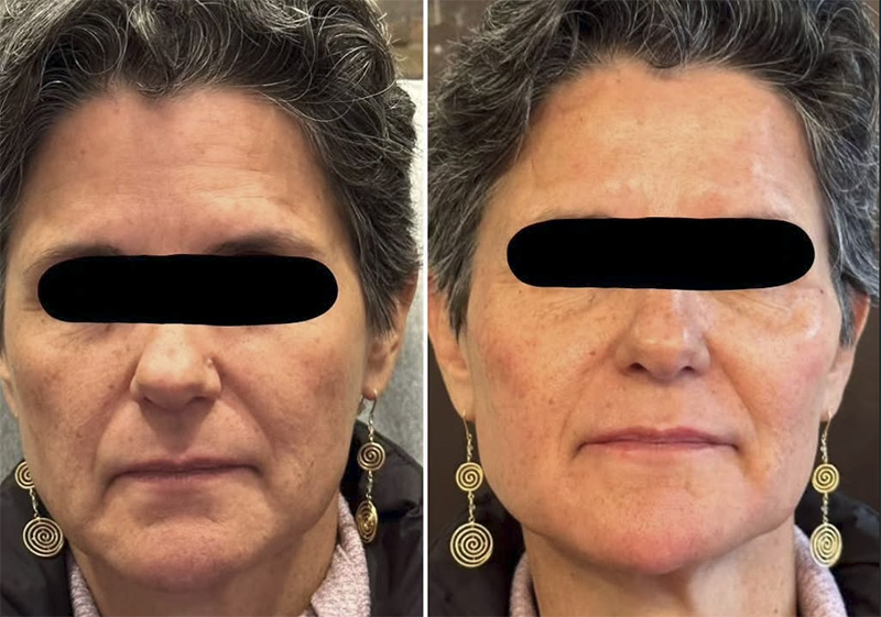 Non-Surgical Facelift w/ Fillers