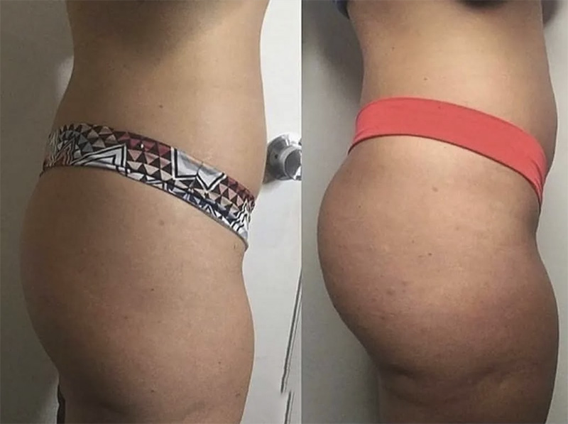 Butt Lift: Achieved with Emsculpt®