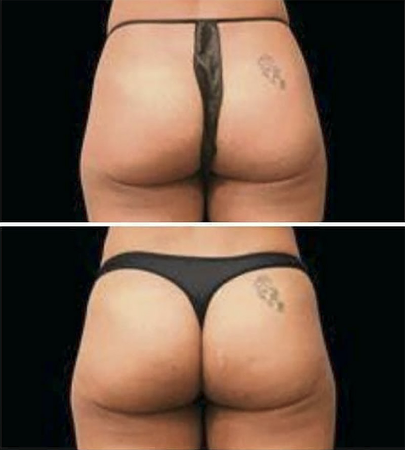 Butt Lift: Achieved with Emsculpt®