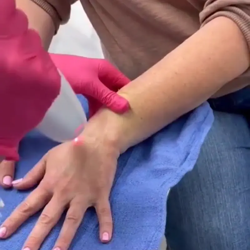 Hand Rejuvenation w/ LaseMD