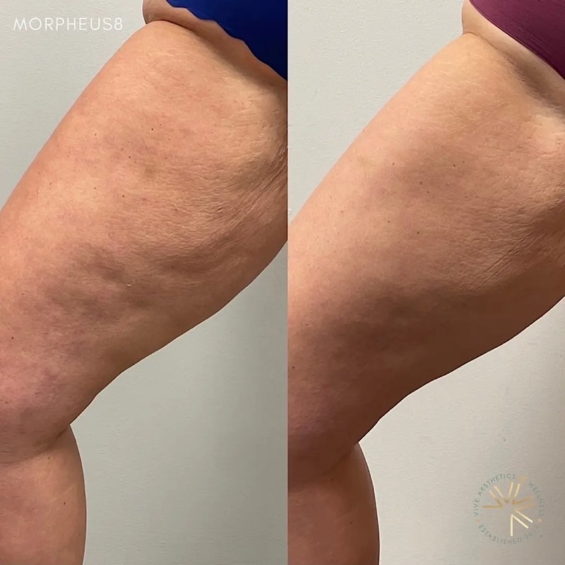 Leg Treatment w/ Morpheus8