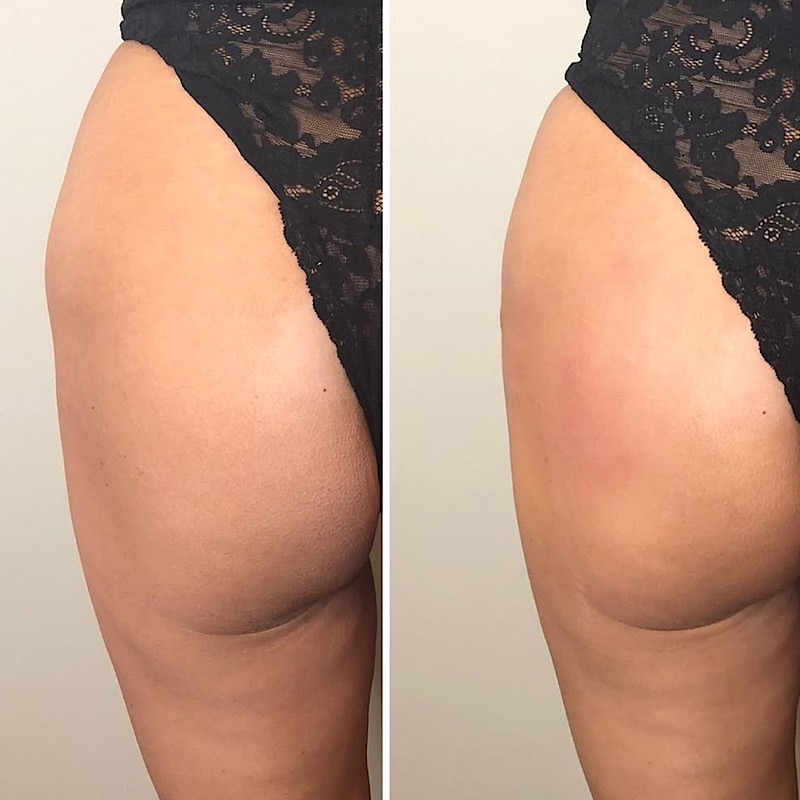 Butt Lift: Achieved With Radiesse
