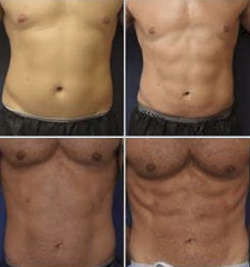 Abs: Achieved with Emsculpt®