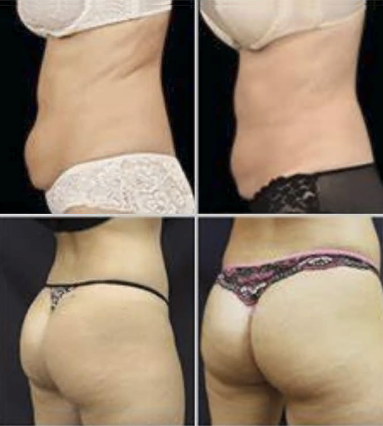 Results Achieved w/ Emsculpt®