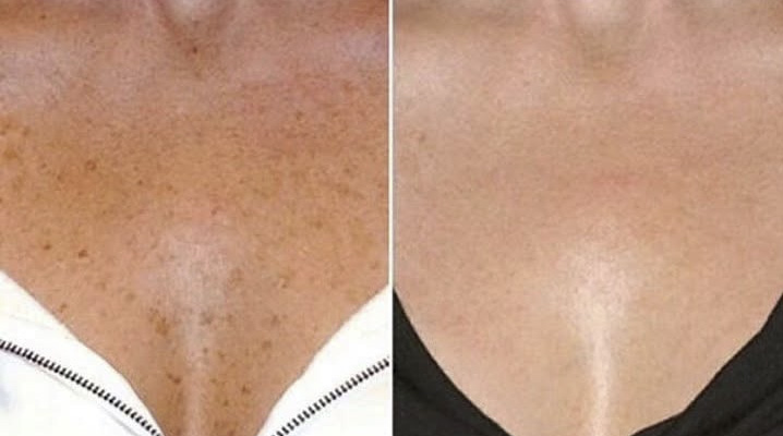 Sun Damage & Pigment Reduction with LaseMD Ultra